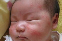 宝宝湿疹治疗 湿疹治疗不可滥用药