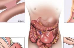 腸套疊症狀 腸套疊的手術療法