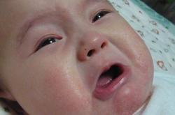 寶寶濕疹怎麼治療 治療嬰兒濕疹的偏方