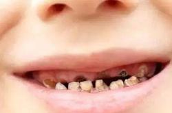 牙齿疾病 预防儿童牙齿疾病的措施