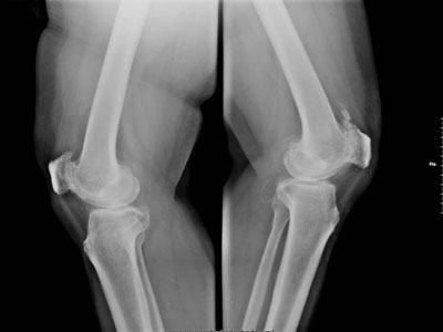 膝盖痛是什么原因 揭秘膝盖疼痛的几种原因