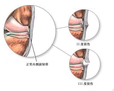 韧带的描述 韧带拉伤的治疗方法