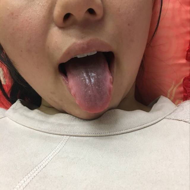 舌苔发黑 通过舌头可以了解人的身体状况