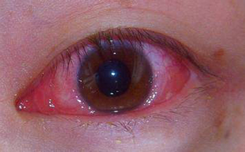 红眼病治疗