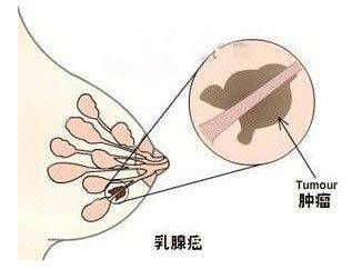 朱莉切乳腺自保 真有乳腺癌基因这东东哦