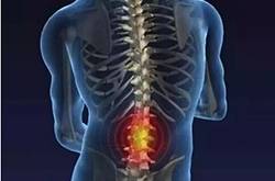 腰椎盘突出怎么锻炼 腰椎盘突出的4大病因