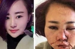 丽江被打女孩近照 女孩被打毁容无法恢复欲自杀