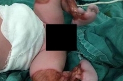 罕见！新生儿双腿透明可见血管和肌肉 病因不明
