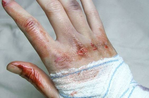 去除烫伤疤痕小窍门有哪些 日常生活要如何预防疤痕