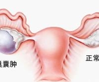 常吃百合茯苓，预防卵巢囊肿