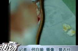广州男子用黄鳝塞肛门通便 结果差点要了他的命