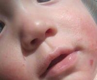 宝宝有湿疹如何食疗？