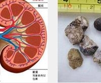 肾结石的饮食保健原则