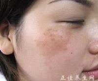 脸上长黄褐斑中医怎么调理？