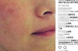 41岁舒淇脸红肿起疹子 崩溃喊道:你还要我怎样？