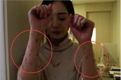 杨幂拍戏擦伤手臂伤口密密麻麻 成龙夸赞敬业：