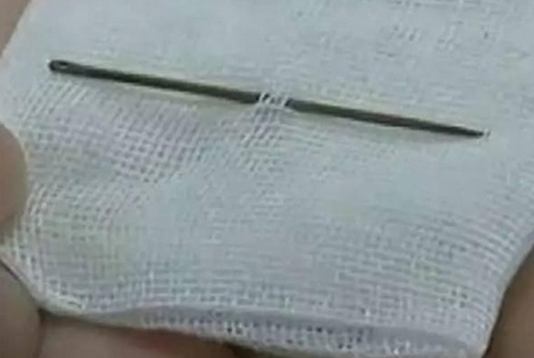 缝衣针插入尿道
