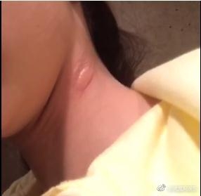 景甜银川拍戏被蚊虫咬出一个很可怕的肿包 看了让人心疼