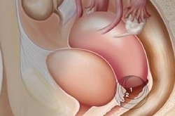 42岁女子同房后出血 下体流血竟是这原因