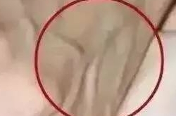 警惕!这个部位青筋暴突,可能你的肝已经硬化..