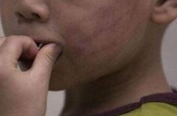 男孩被铁丝打伤下体 生殖器受伤患上抑郁症